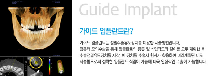 임플란트는? 라임나무치과만의 특화 임플란트 관련 이미지 5