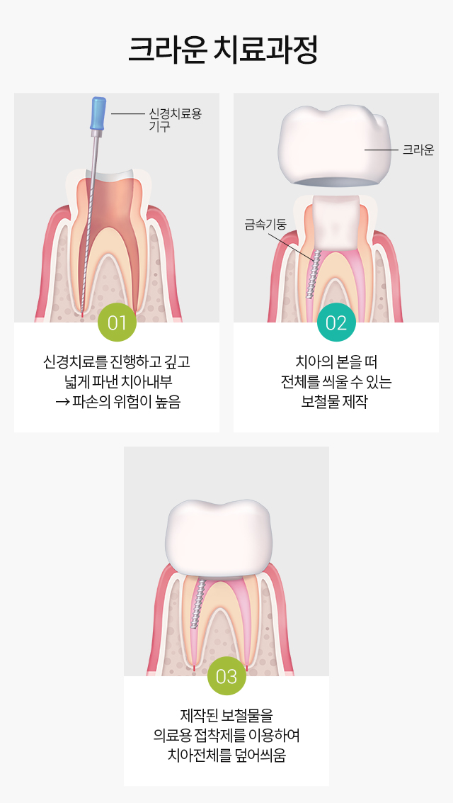 명동치과, 지르코니아 vs 금 ? 관련 이미지 4