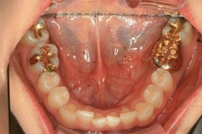 [의료진 교정일기]투명교정으로 아랫니 치열 바로잡기 관련 이미지 4