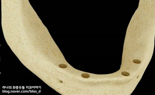 임플란트 틀니가 틀니보다 나은 이유 3가지 관련 이미지 3
