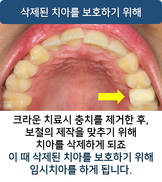 임시치아 빠짐, 빠졌을 때 어떻게? 명동 라임나무치과 관련 이미지 4