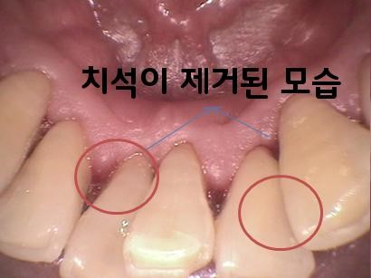 스케일링 전후 사진으로 알아보는 스케일링 효과 관련 이미지 4