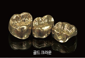 치아를 씌우는 크라운 보철치료! PFM크라운? 지르코니아? 어떤 종류가 있나요? 관련 이미지 3