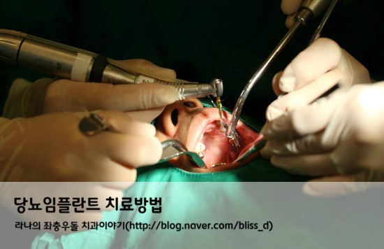 당뇨임플란트 치료방법 관련 이미지 1