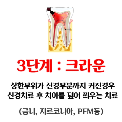 [충치치료종류] 충치치료 언제까지 참으실건가요?? 관련 이미지 7