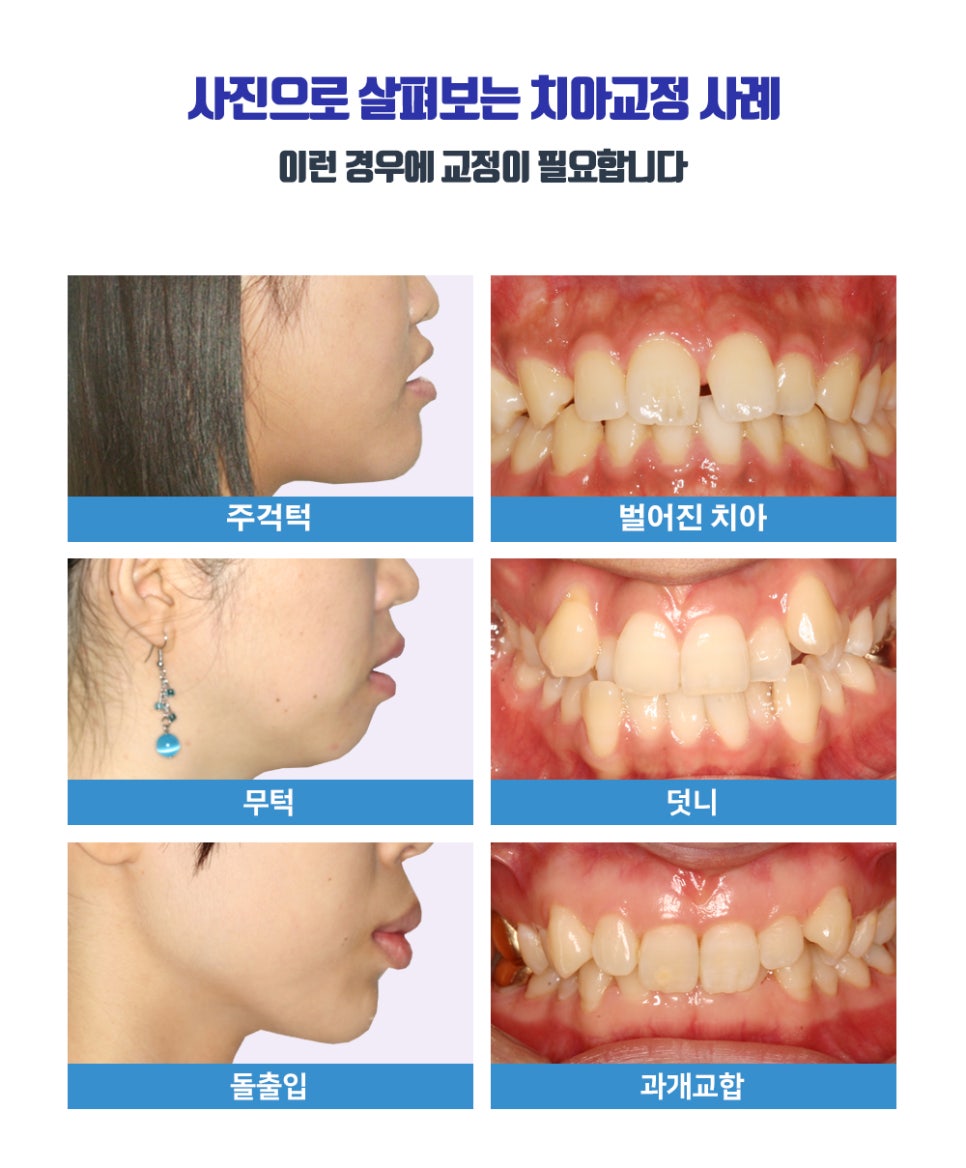 치아교정 시작 전, 알아둬야 할 체크포인트 관련 이미지 3