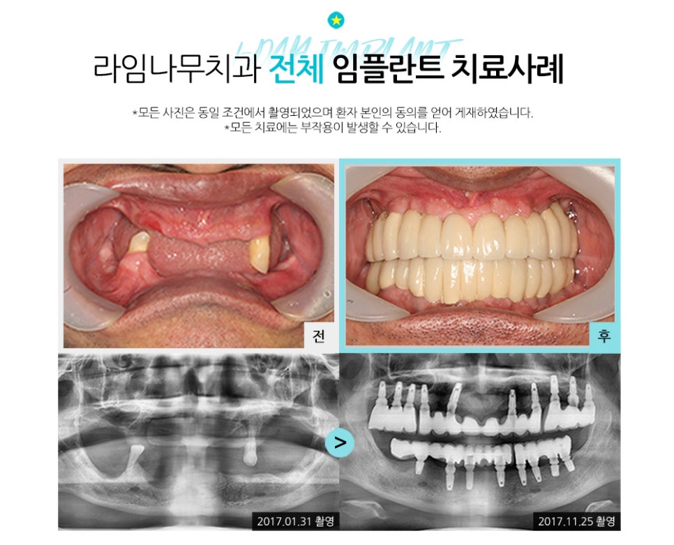 임플란트, 단돈 40만원으로 할 수 있다고요? 관련 이미지 6