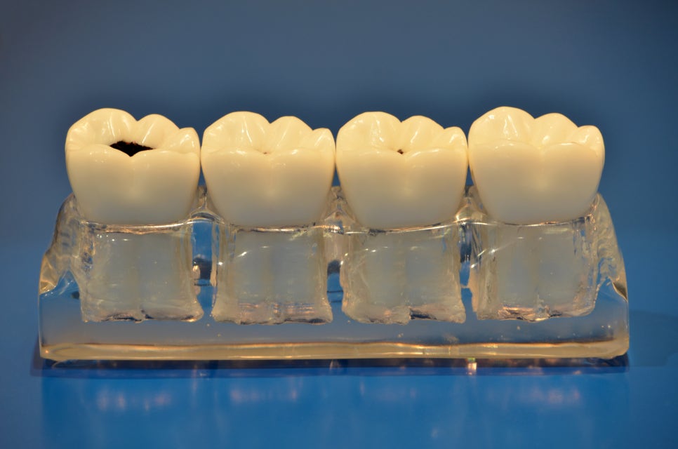 치아를 씌우는 크라운 보철치료! PFM크라운? 지르코니아? 어떤 종류가 있나요? 관련 이미지 5