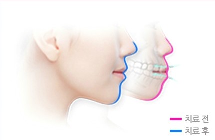 돌출입의 정의와 돌출입 교정에 대한 모든 것을 공개합니다 관련 이미지 3