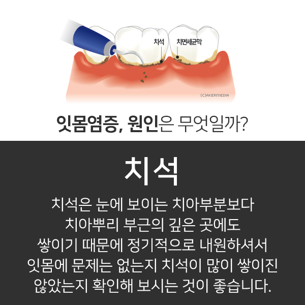 피곤하면 붓는 잇몸질환의 원인과 해결방법 관련 이미지 2