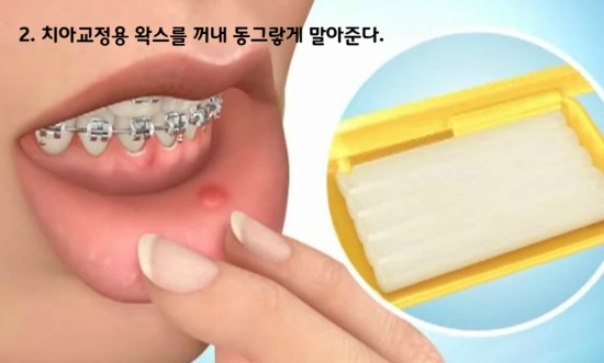 치아교정 치료 노하우 BEST3 관련 이미지 3