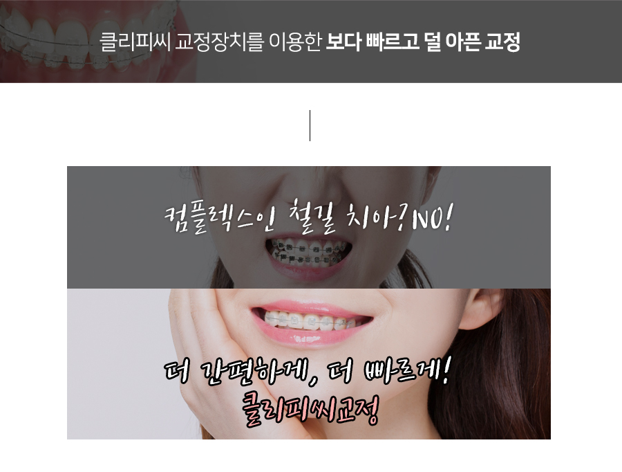 클리피씨 교정장치를 이용한 보다 빠르고 덜 아픈 교정 관련 이미지 2