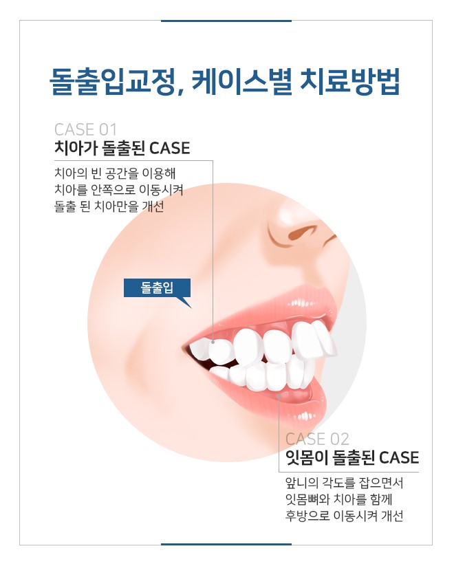 명동치과에서 비발치교정 시작해 보세요 관련 이미지 3