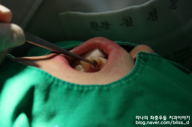 치아교정 치과를 옮길 때 발생할 수 있는일 관련 이미지 4