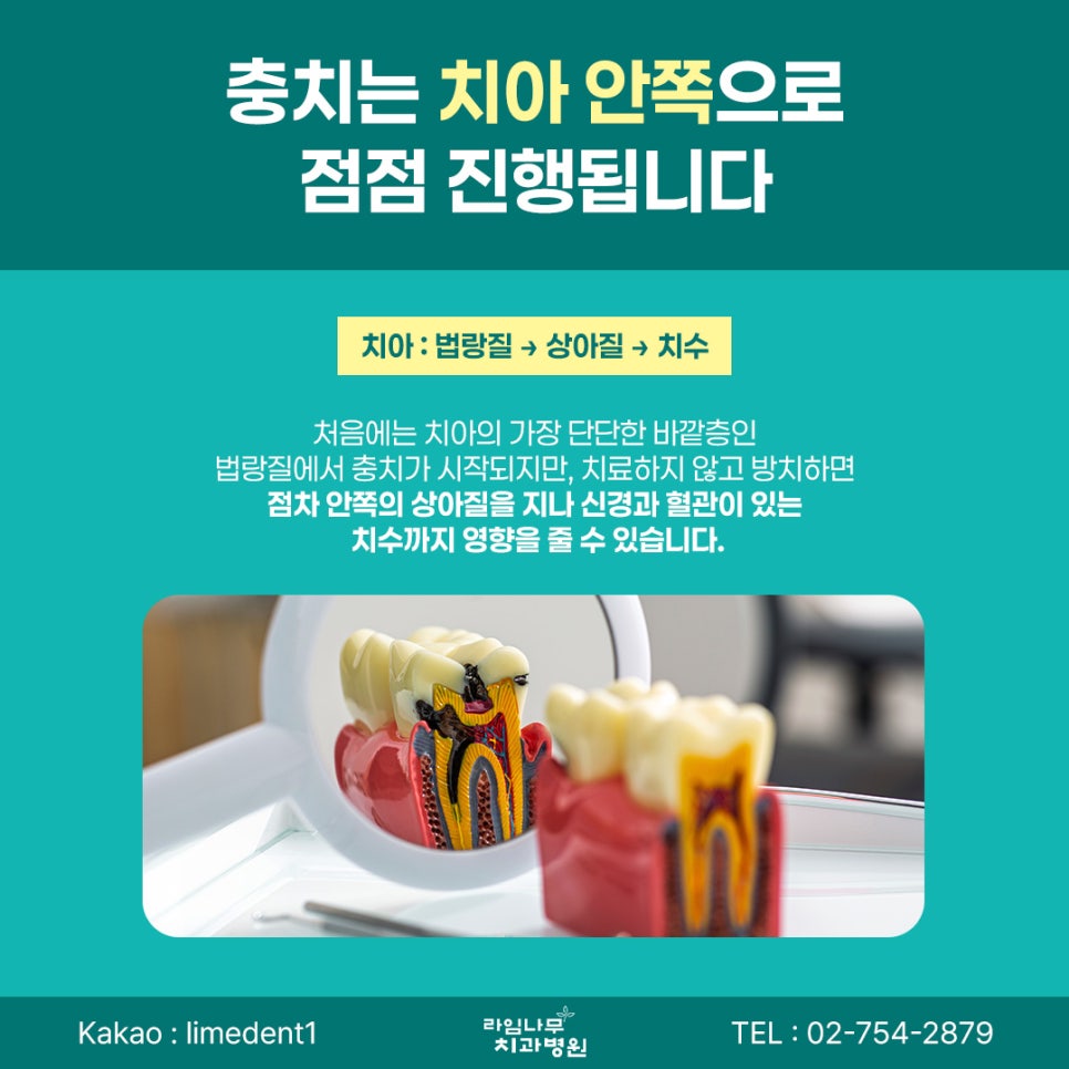 명동 치과 충치는 어느 단계부터 신경치료가 필요할까요? 관련 이미지 3