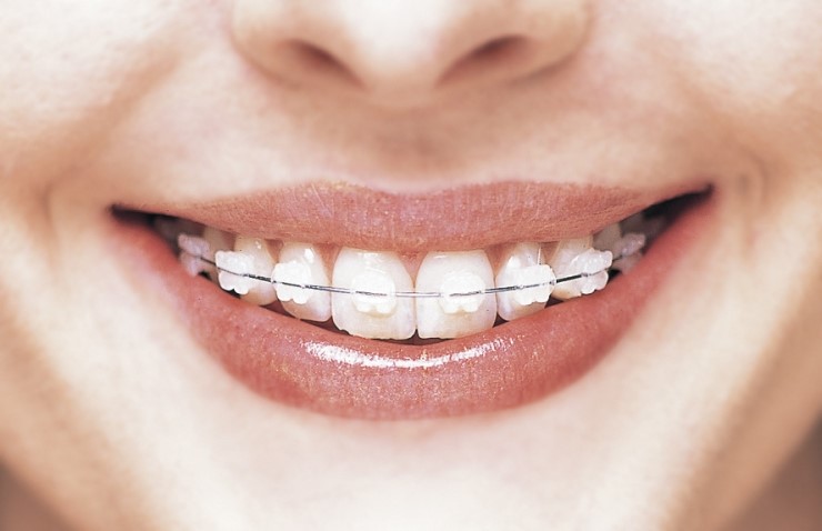 부정교합이란 무엇이며, 어떻게 치료할 수 있을까요 관련 이미지 9