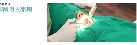 한 눈에 보는 치아미백 Vol2 - 치아미백 치료방법 관련 이미지 4