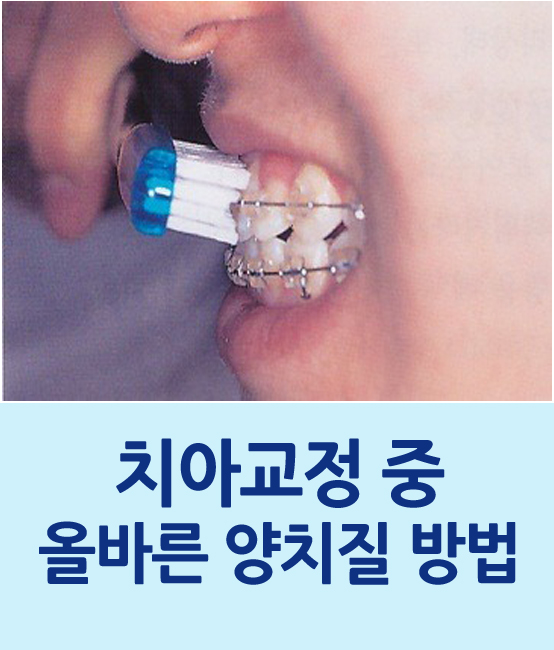 치아교정 중 양치질은 어떻게 하는 것이 좋을까 관련 이미지 1