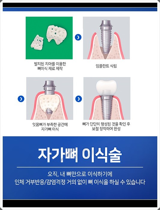 라임나무치과 오스템임플란트 비용이 궁금하셨다고요? 관련 이미지 9