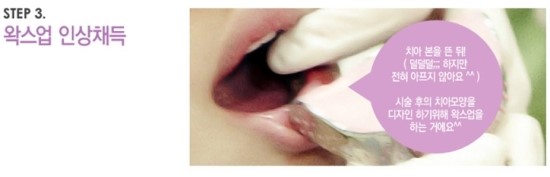 한 눈에 보는 라미네이트 : 라미네이트 치료 진행과정 관련 이미지 4