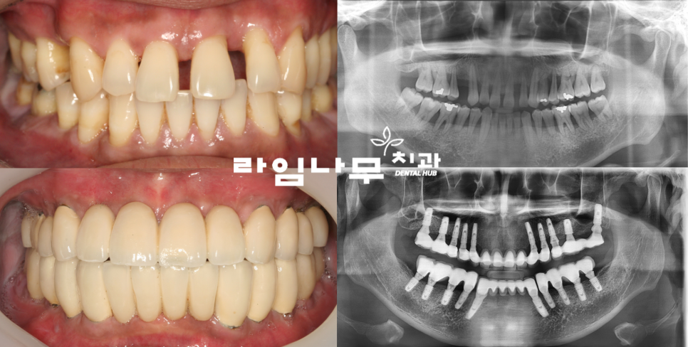 명동치과 전체임플란트 증례! 치주염으로 전체 치아의 기능을 상실한 치아 관련 이미지 8