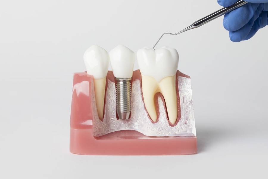 임플란트 심으면 끝인가요? 관리는 어떻게 해야하죠? 라임나무치과 임플란트 관리법 관련 이미지 5