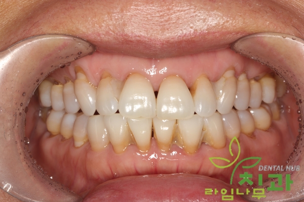 연예인 치아 성형 라미네이트, 치아 급속 교정 가능해요! 명동치과 라임나무치과 관련 이미지 5