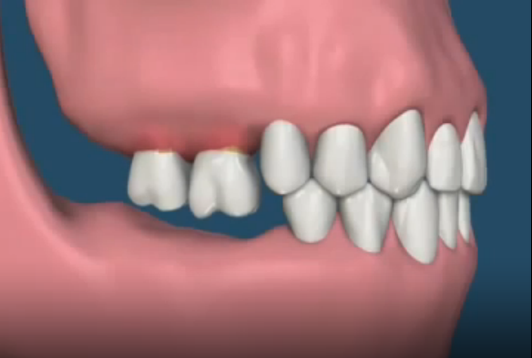 씹는 즐거움! 씹기의 중요성 알아보아요 명동치과 라임나무치과 관련 이미지 4