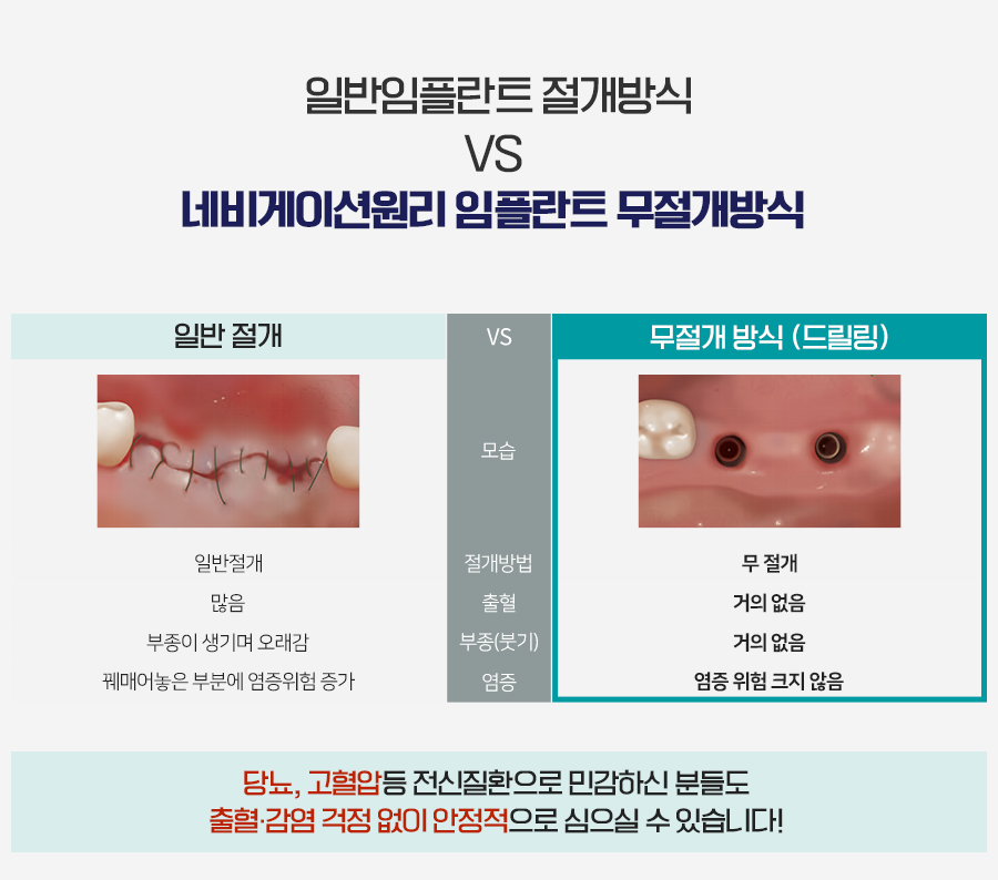 치료기간 걱정 덜어주는 당일임플란트 관련 이미지 5