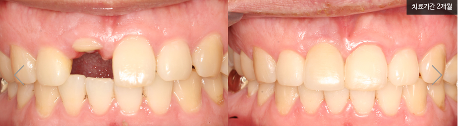 앞니 임플란트 후기 티나지 않아요 명동치과 라임나무 관련 이미지 6