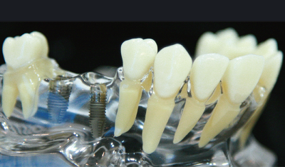 을지로치과가 알려드리는 임플란트 건강보험 적용 관련 정보 관련 이미지 3