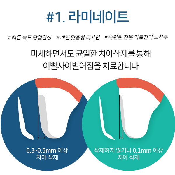 치아사이벌어짐, 라미네이트? 부분교정? 선택은! 관련 이미지 2