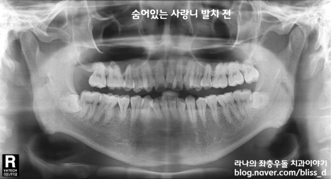 사랑니 발치 잘하는 명동치과 어디? 관련 이미지 3