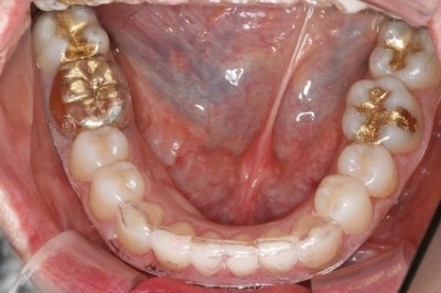 [의료진 교정일기]투명교정으로 아랫니 치열 바로잡기 관련 이미지 5