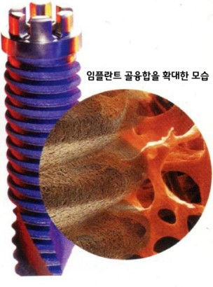 임플란트 골융합이 중요한 이유 관련 이미지 5