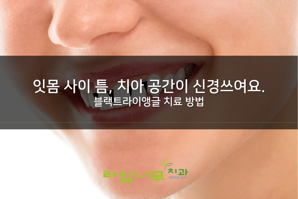 명동치과 잇몸 사이 틈? 치아 공간이 신경 쓰여요. 블랙트라이앵글/라임나무치과 관련 이미지 1