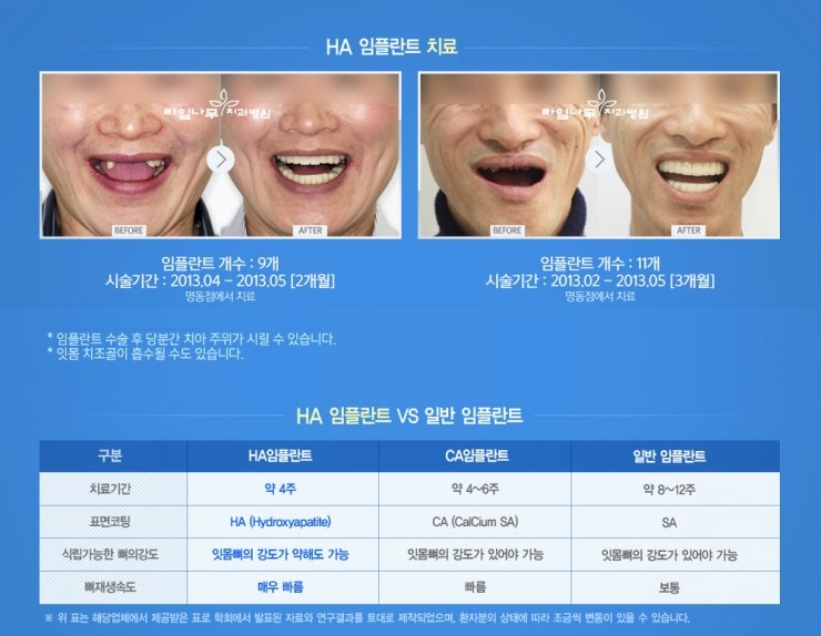 임플란트 틀니를 고려중이시라면 관련 이미지 2