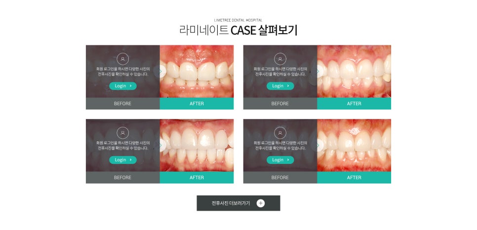 치아교정보다 빠른효과 나타내는 최소삭제 라미네이트! 관련 이미지 3
