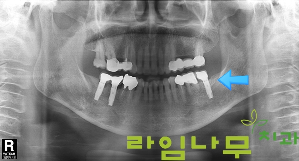 임플란트 재수술 증례! 믿을만한 곳 명동치과 라임나무치과 관련 이미지 4