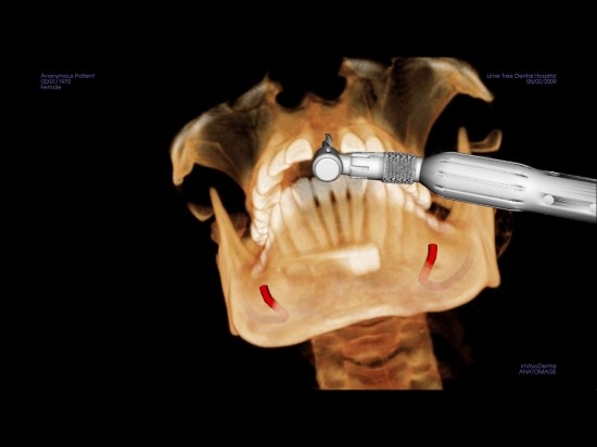 당뇨임플란트 치료방법 관련 이미지 8