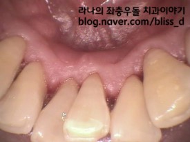 년1회 스케일링 건강보험 적용 확정! 관련 이미지 3