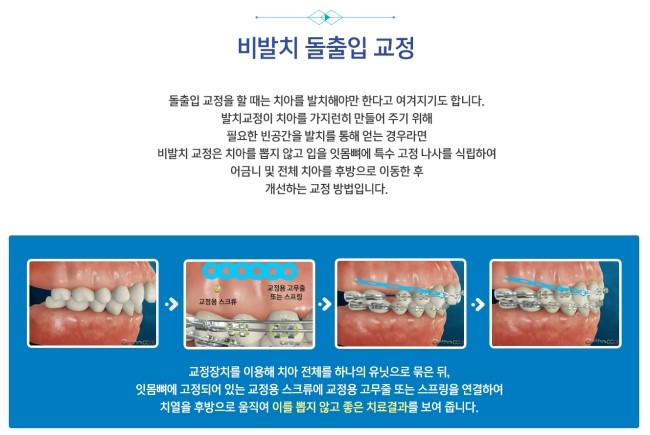 비발치 돌출입 교정 어떻게 가능할까요? 관련 이미지 3