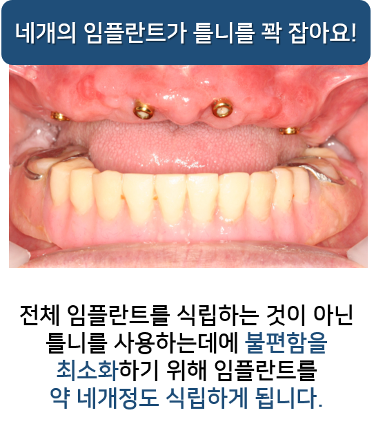 명동치과 만족도 높은 임플란트 틀니 알아보기! 라임나무 관련 이미지 4