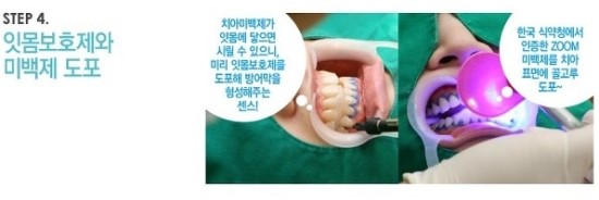 한 눈에 보는 치아미백 Vol2 - 치아미백 치료방법 관련 이미지 5