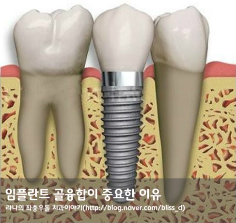 임플란트 골융합이 중요한 이유 관련 이미지 1