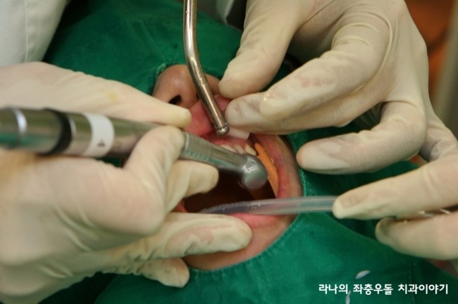라미네이트 가격 VS 라미네이트 잘하는 명동치과 관련 이미지 2