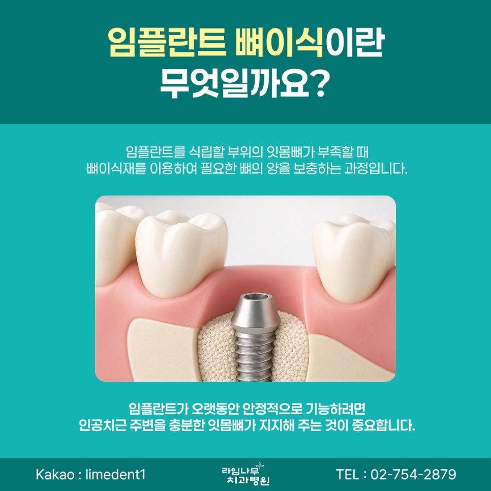 명동 임플란트, 임플란트 뼈이식은 어떤 경우에 필요할까요? 관련 이미지 3