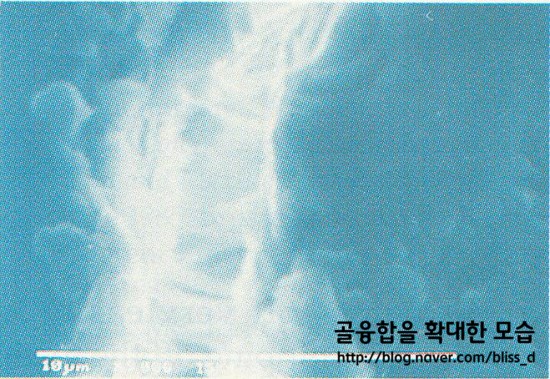 성공적인 임플란트를 위한 표면처리 기술 얼마나 알고 계신가요? 관련 이미지 2