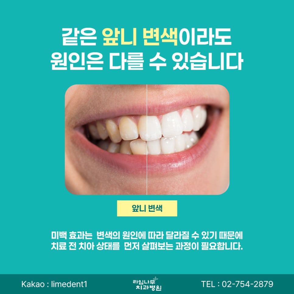 Myeongdong Laminate Veneers: How Do Laminate Veneers and Teeth Whitening Differ for Front-Tooth Concerns? image 3
