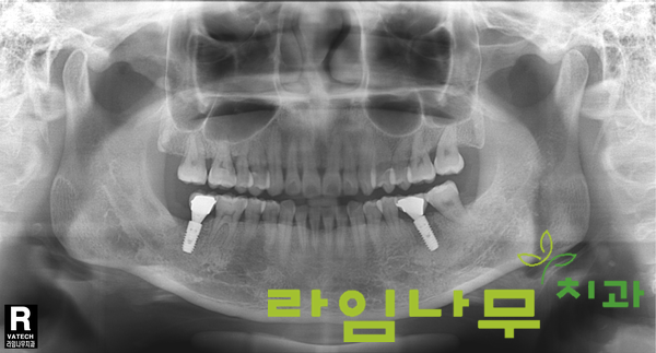 임플란트 재수술 증례! 믿을만한 곳 명동치과 라임나무치과 관련 이미지 6